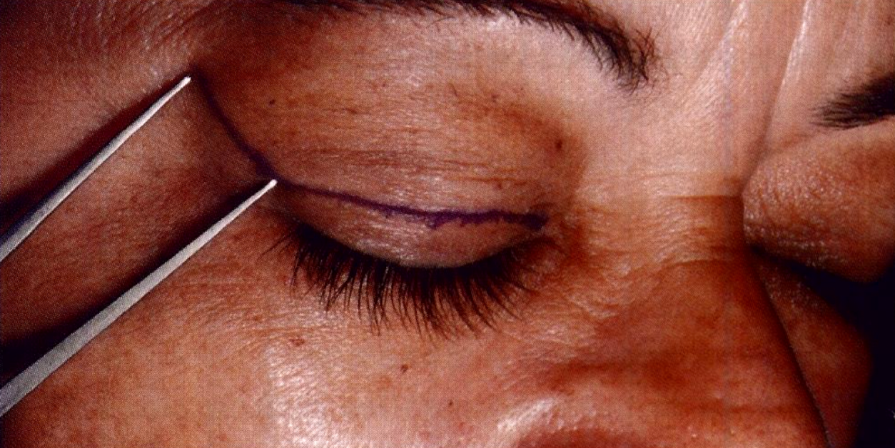 Imagem mostrando como é o planejamento da cicatriz de uma cirurgia plástica palpebral. A blefaroplastia é planejada na dobrinha do olho, onde está a linha azul da foto, ficando bem escondida.