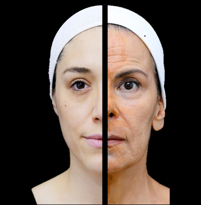 Envelhecimento das estruturas da face, que podem ser beneficiadas pela cirurgia de ritidoplastia para rejuvenescimento. Esta cirurgia plástica pode ser realizada em Catalão para o lifting da face.
