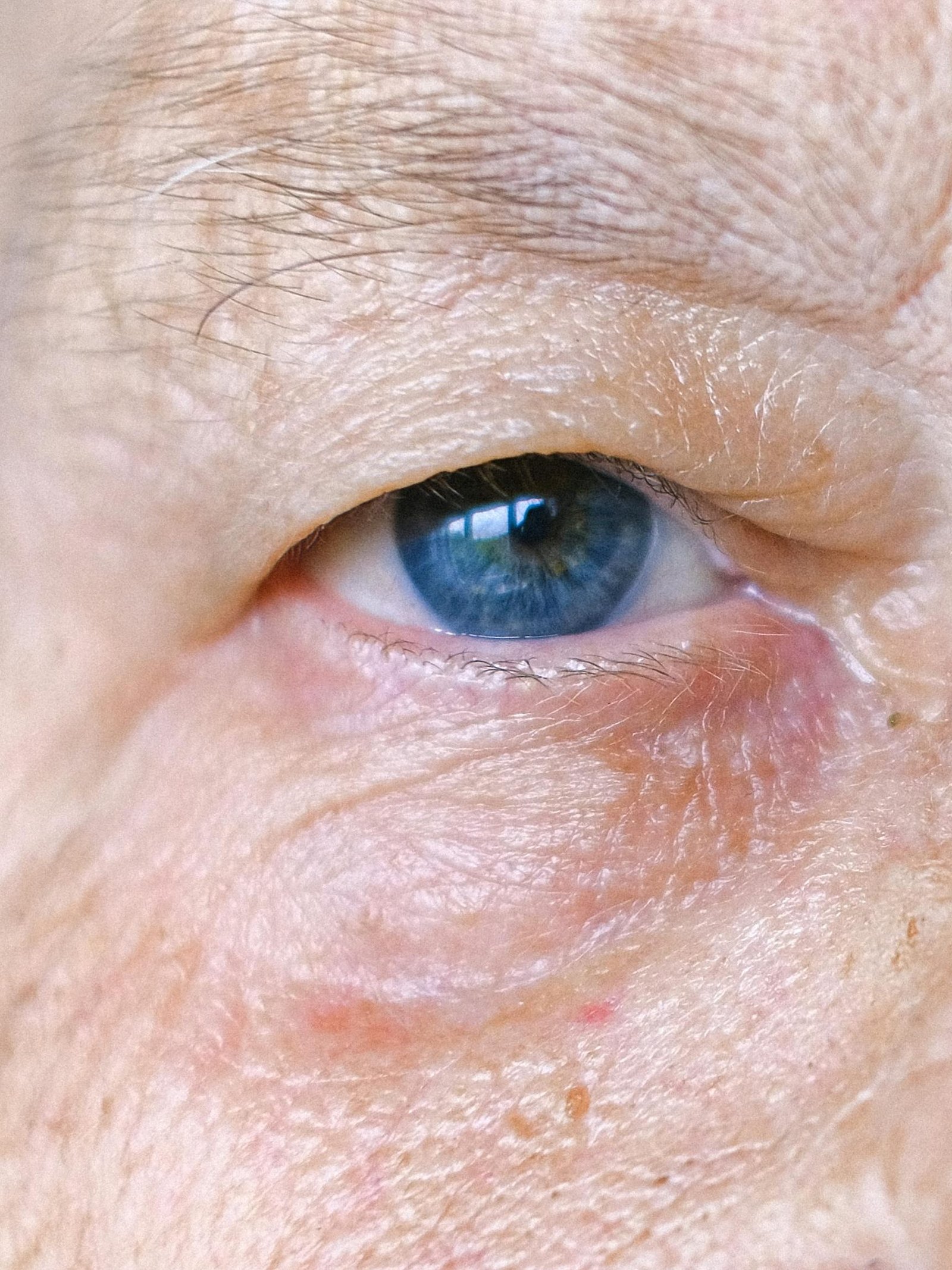 Olhar envelhecido com excesso de pele na pálpebra superior e excesso de pele na pálpebra inferior. Além disso, bolsas de gordura nos olhos. A blefaroplastia é a cirurgia plástica para melhorar estas características.