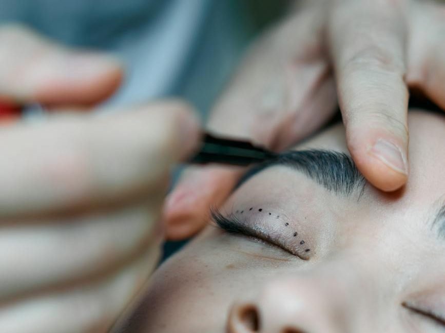 Imagem mostrando a marcação de uma cirurgia plástica de pálpebras. A cirurgia plástica facial, como a blefaroplastia, continua sendo importante aliada para os procedimentos minimamente invasivos e cosmiatria.