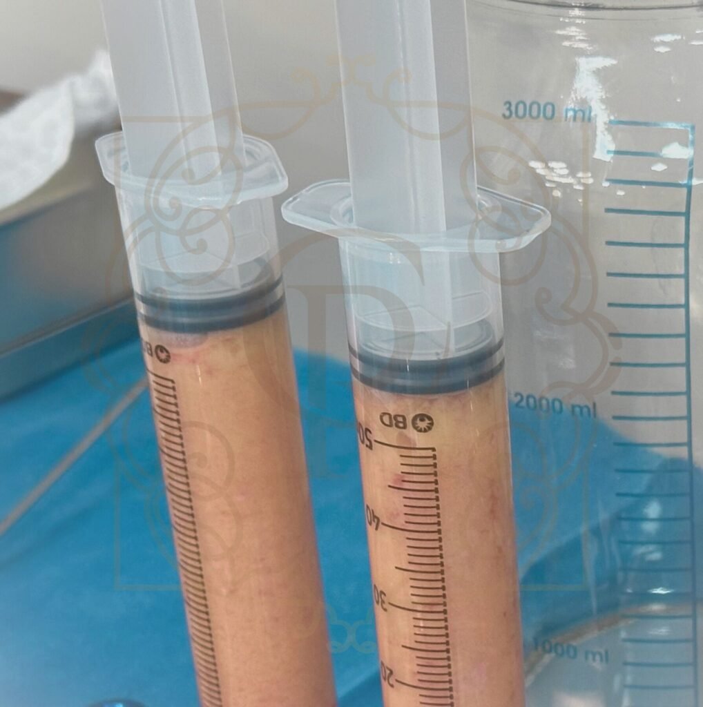 Gordura purificada e decantada consegue fornecer os principais benefícios da lipoenxertia.