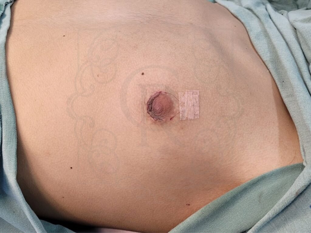 Podemos observar o aspecto final após o término da cirurgia de ginecomastia em Catalão. O peitoral está mais plano e sem glândula mamária, que são os principais incômodos dos homens.