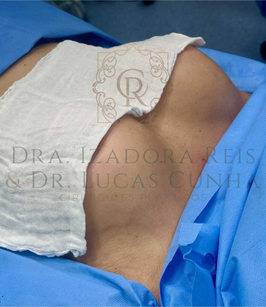 Fotografia mostrando o colo de uma cirurgia plástica de mastopexia com prótese de silicone realizada pela Dra. Izadora Reis e pelo Dr. Lucas Cunha em Catalão.