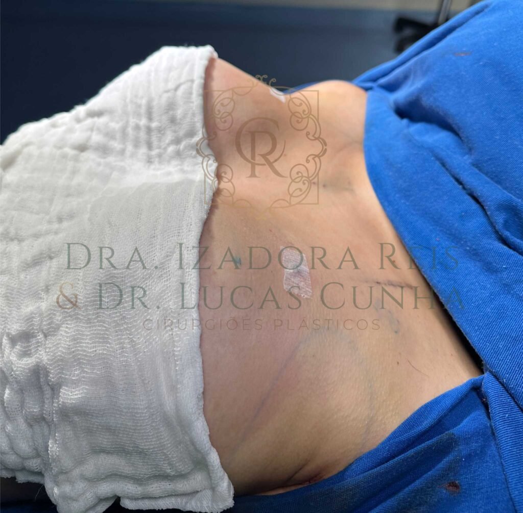 Cirurgia Plástica de Mastopexia sem prótese de silicone realizada pelo Dr. Lucas Cunha e Dra. Izadora Reis em Catalão. Foto para demonstrar o colo mais natural e menos marcado do que quando se utiliza próteses.
