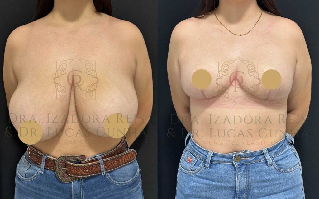 Antes e depois de mamoplastia redutora realizada em Catalão pela Dra. Izadora Reis e pelo Dr. Lucas Cunha.