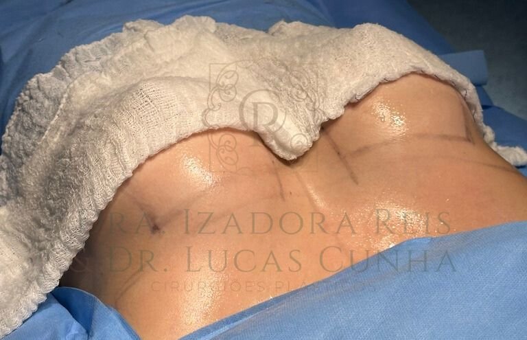 A cirurgia de silicone em Catalão consegue dar um colo bem marcado e definido após a cirurgia.