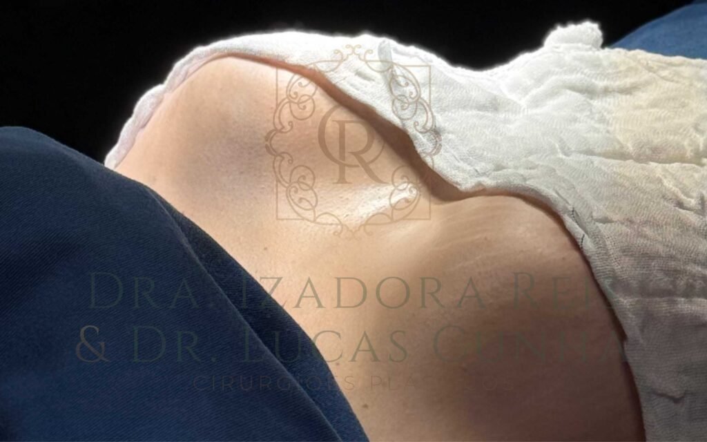 Mamoplastia Redutora realizada em Catalão pela Dra. Izadora Reis e pelo Dr. Lucas Cunha. Trata-se de cirurgia reparadora que melhora a qualidade de vida e vai muito além da estética.