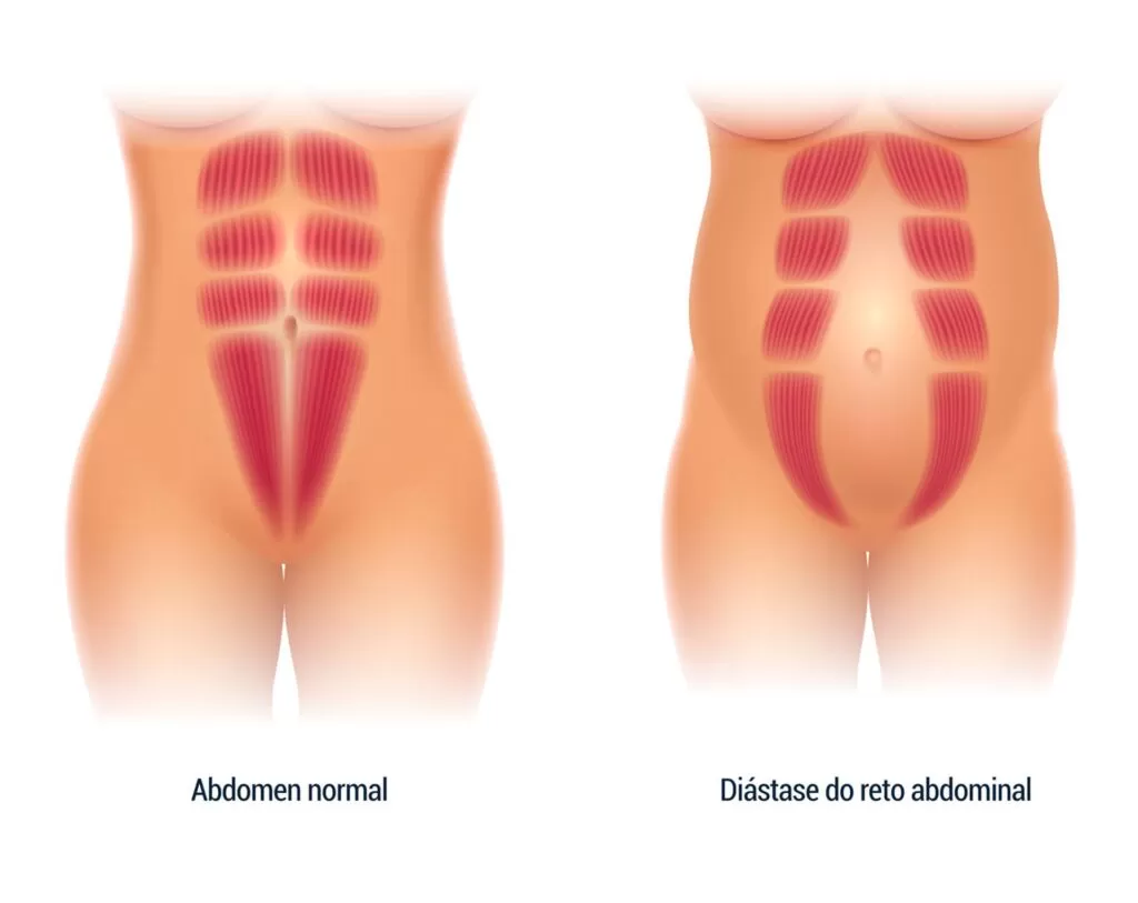 A diástase abdominal ocorre pelo afastamento muscular, gerando um ponto de fraqueza e abaulamento no centro do abdome. Além disso, contribui para diminuir a definição da cintura.