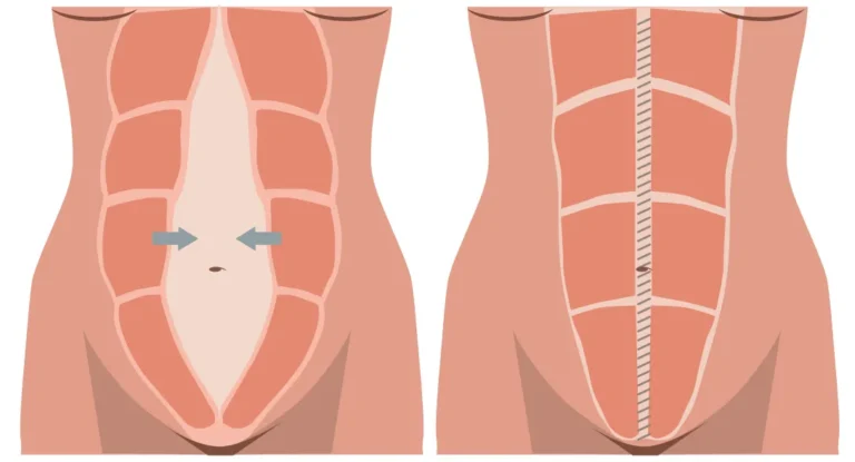 A cirurgia plástica para correção da diástase abdominal deve realizar a plicatura, trazendo de volta o músculo reto abdominal para sua posição original.