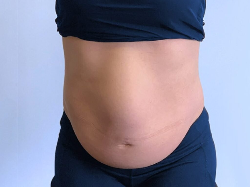 Intensa diástase abdominal quando se contrai o abdome. A correção cirúrgica da díastase depende da cirurgia plástica.